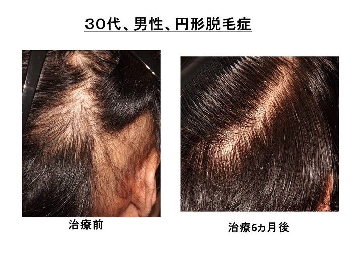円形脱毛症　病院""